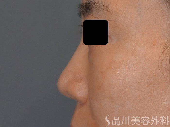 症例NO.71422のBEFORE写真