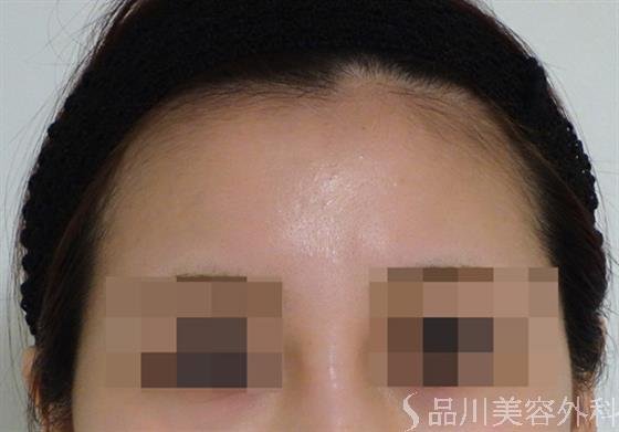 症例NO.46427のBEFORE写真