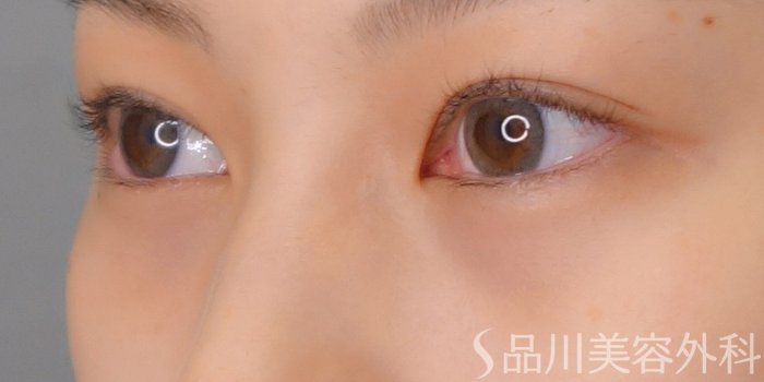 症例NO.69651のAFTER写真