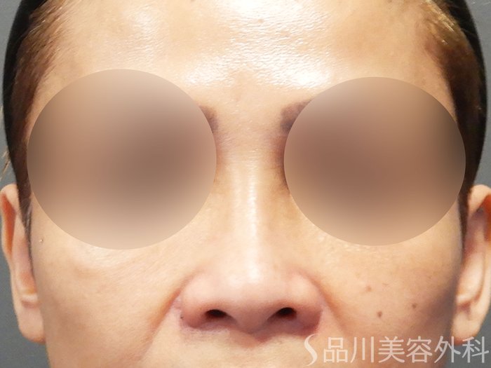 症例NO.74188のAFTER写真