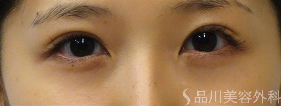 症例NO.38173のAFTER写真