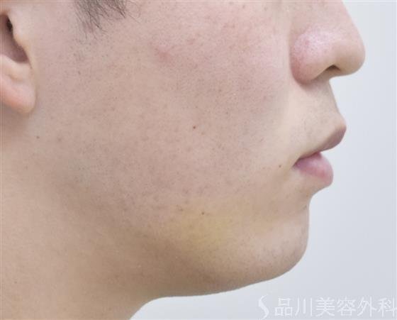 症例NO.47917のAFTER写真