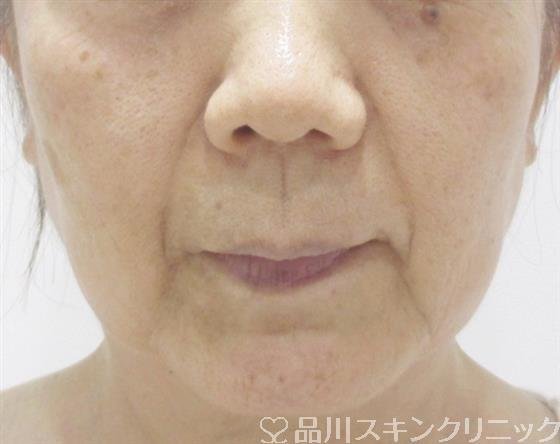 症例NO.36794のBEFORE写真