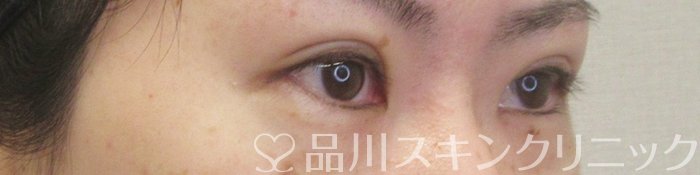 症例NO.73935のAFTER写真