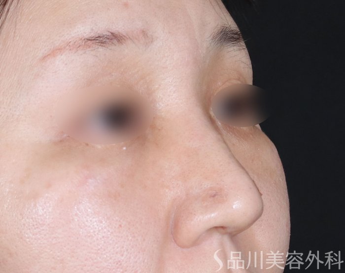 症例NO.72589のAFTER写真