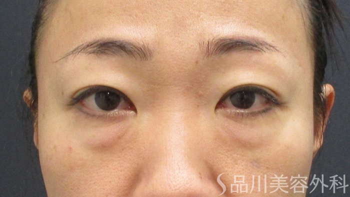 症例NO.65441のBEFORE写真