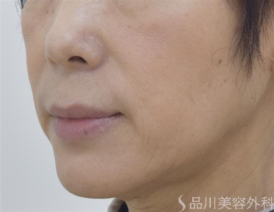 症例NO.45358のBEFORE写真