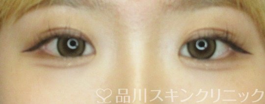 症例NO.68403のAFTER写真