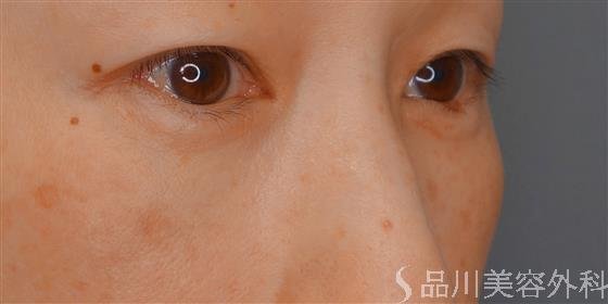 症例NO.59537のAFTER写真