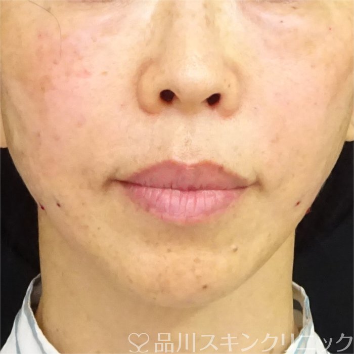 症例NO.69508のAFTER写真