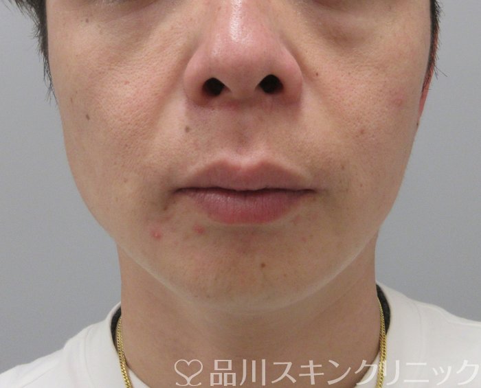 症例NO.73746のBEFORE写真