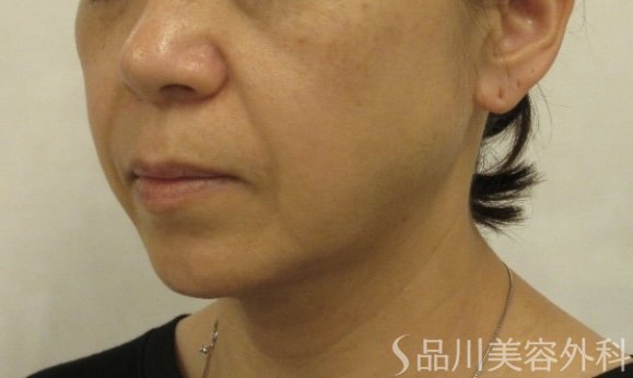 症例NO.72193のBEFORE写真