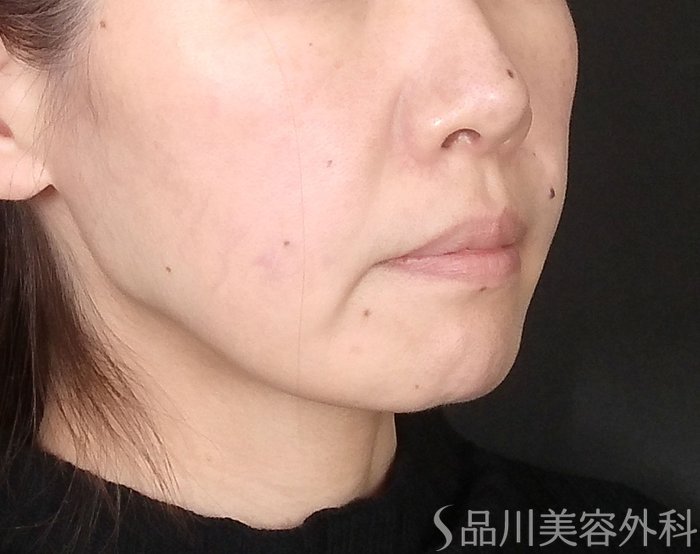 症例NO.69646のBEFORE写真