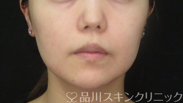 症例NO.72624のAFTER写真