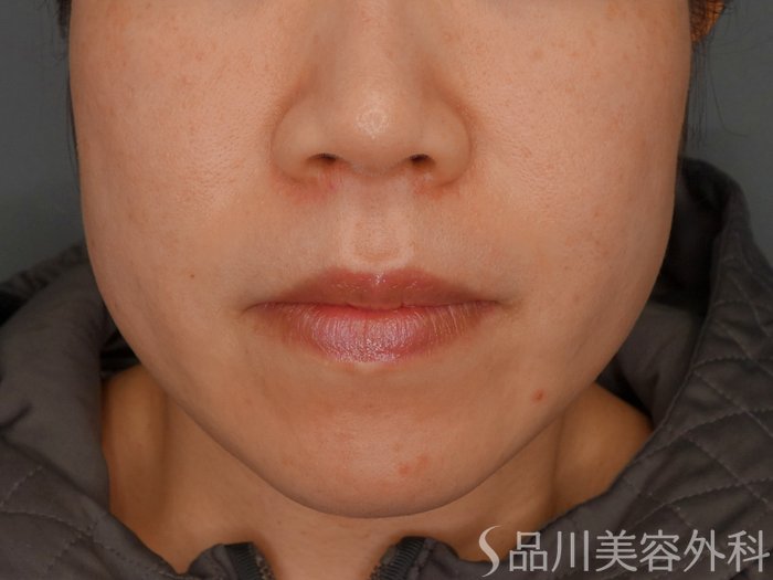 症例NO.73613のAFTER写真