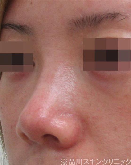 症例NO.29911のBEFORE写真