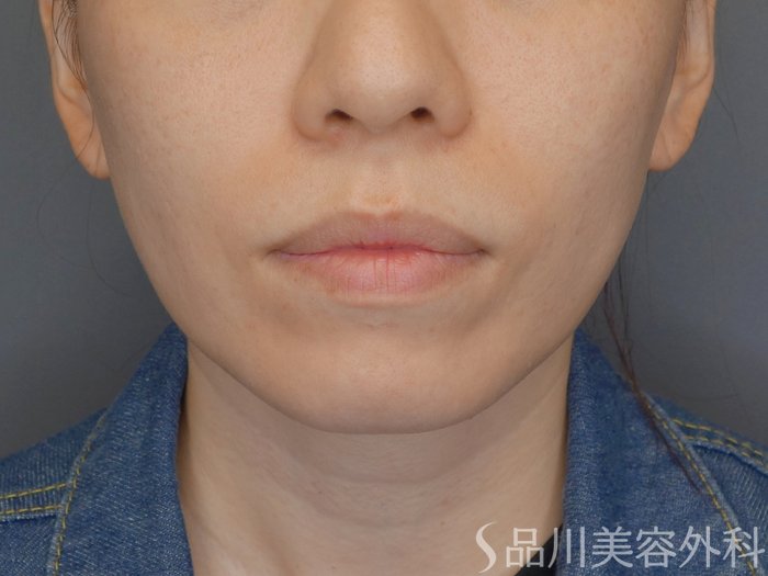 症例NO.71646のBEFORE写真