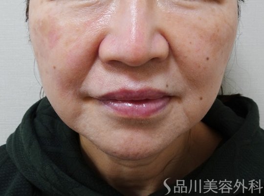 症例NO.73731のAFTER写真