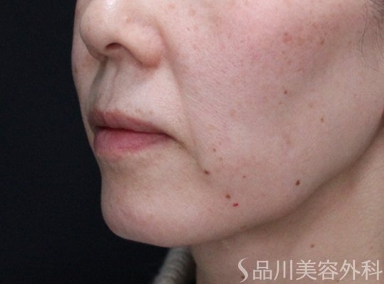 症例NO.72469のBEFORE写真