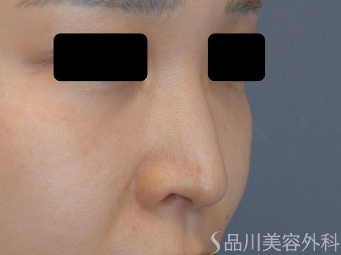 症例NO.70532のBEFORE写真