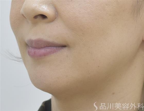 症例NO.45253のBEFORE写真