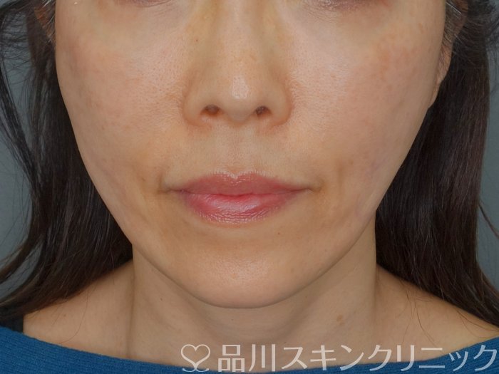 症例NO.73983のAFTER写真