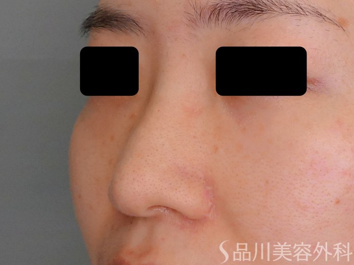 症例NO.70609のBEFORE写真
