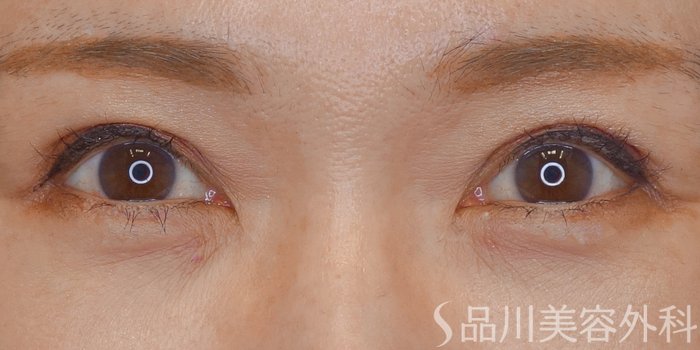 症例NO.72104のAFTER写真