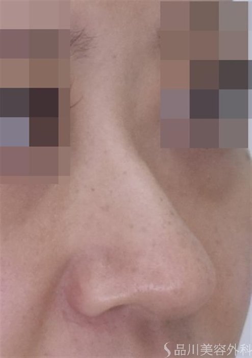 症例NO.51562のBEFORE写真