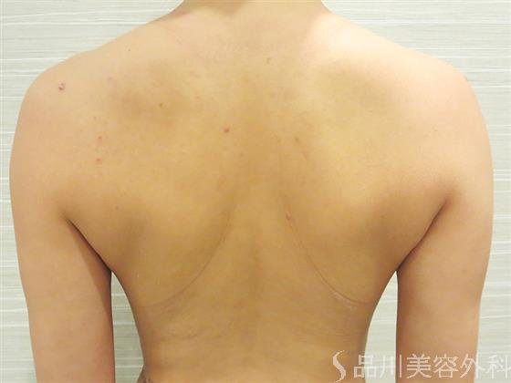 症例NO.23465のBEFORE写真