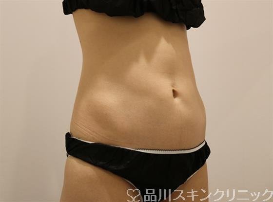 症例NO.45099のBEFORE写真