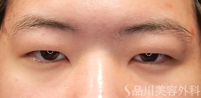 症例NO.72454のBEFORE写真