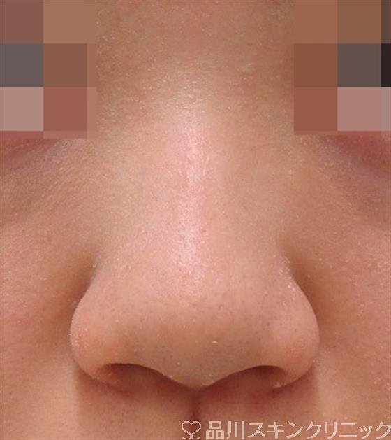 症例NO.40816のBEFORE写真
