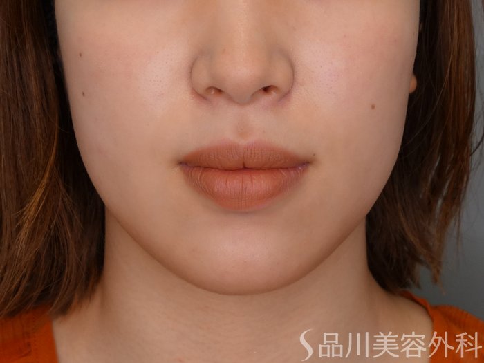 症例NO.69737のBEFORE写真