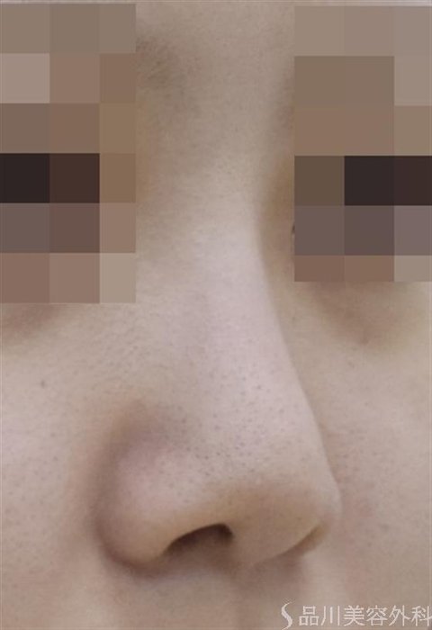 症例NO.54368のBEFORE写真