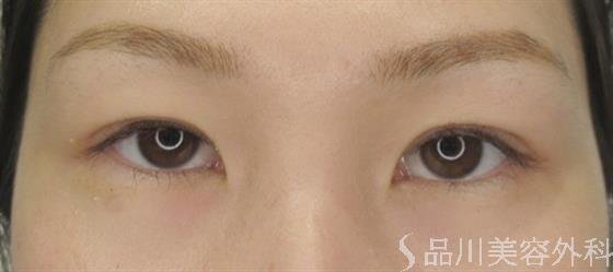 症例NO.48617のAFTER写真