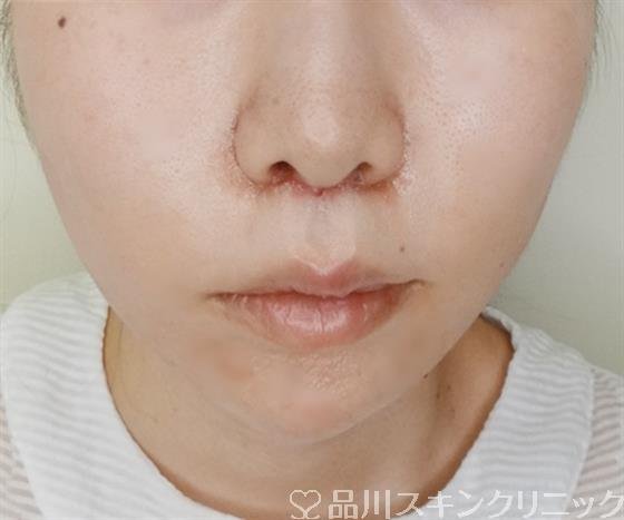 症例NO.48528のAFTER写真
