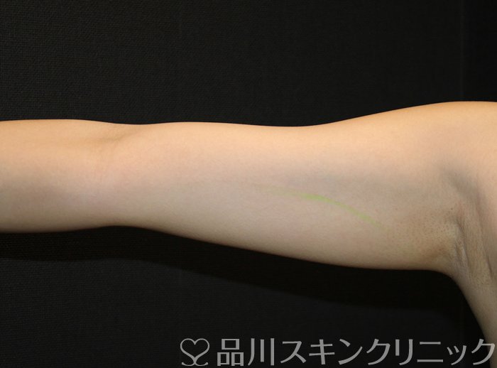 症例NO.74271のBEFORE写真