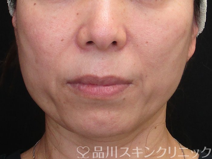 症例NO.72922のBEFORE写真