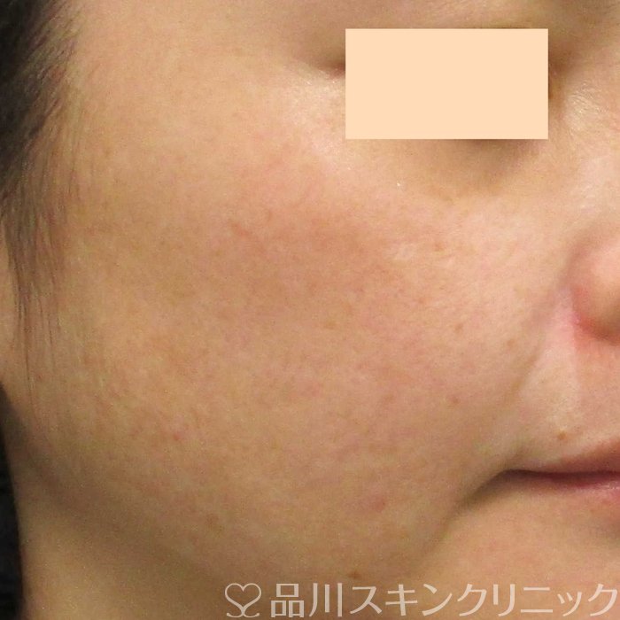 症例NO.69341のBEFORE写真
