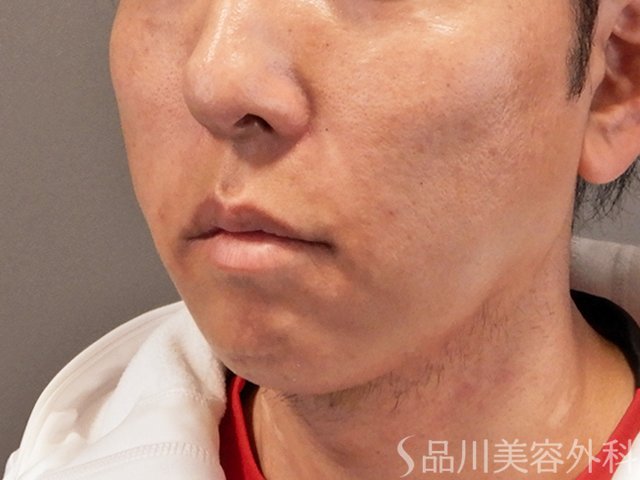 症例NO.70490のAFTER写真