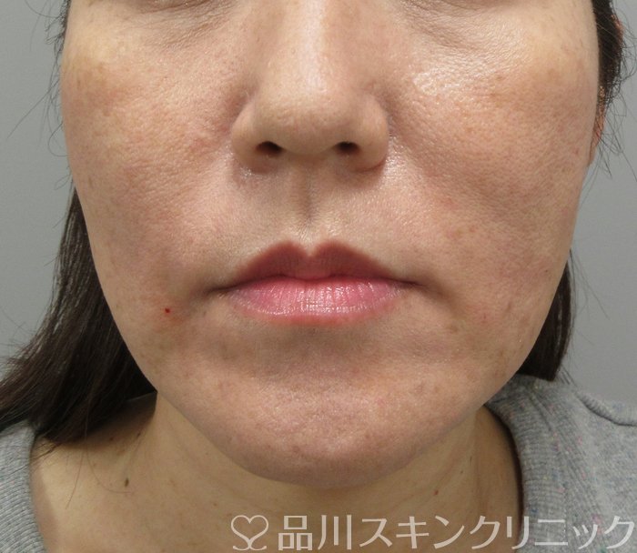 症例NO.73644のAFTER写真