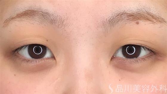 症例NO.60097のBEFORE写真