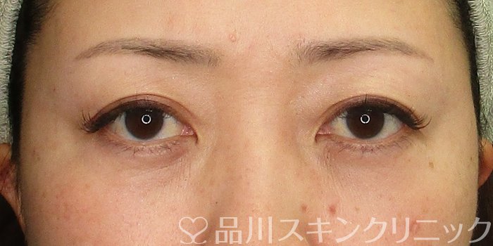 症例NO.70065のAFTER写真