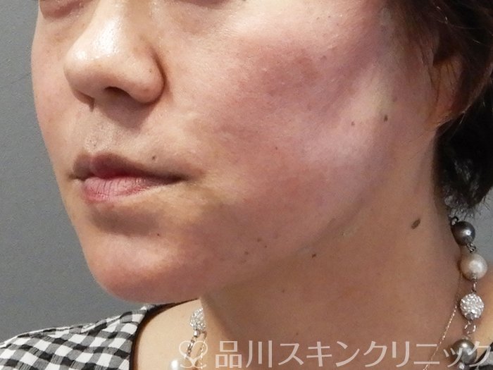 症例NO.71855のAFTER写真