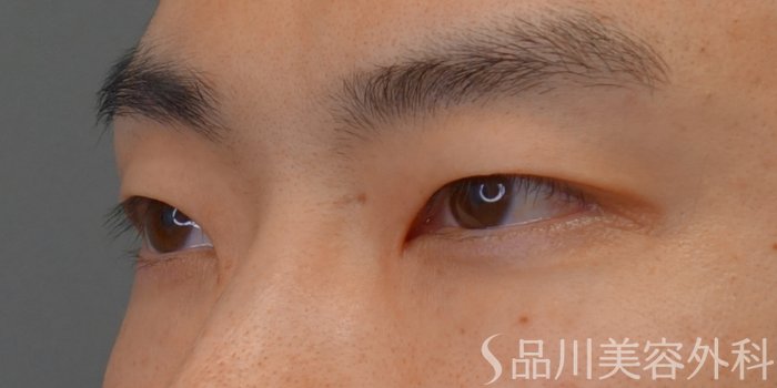 症例NO.74969のBEFORE写真