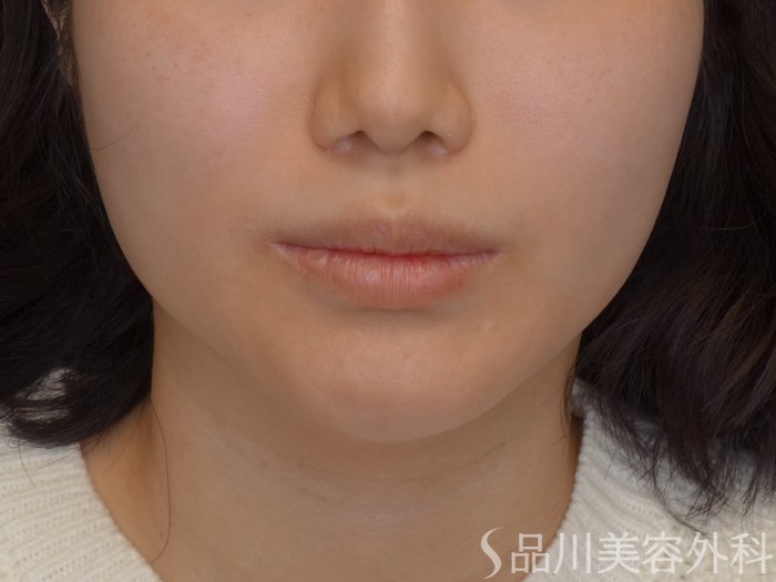 症例NO.72840のBEFORE写真