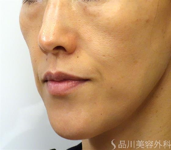 症例NO.37613のBEFORE写真