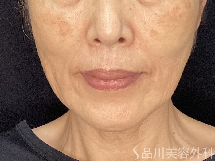 症例NO.71968のBEFORE写真