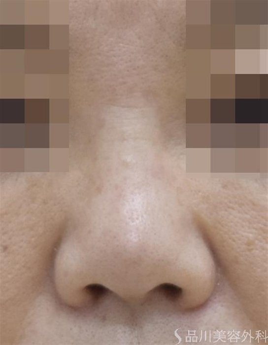 症例NO.51712のBEFORE写真